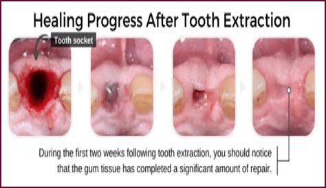 How long does it take for a molar extraction to heal?